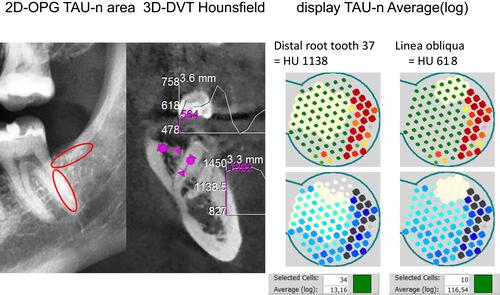 Figure 5 Two areas of increased density: The distal root of tooth 37 and the cortical density of oblique line as the upper rim of area 38. The left image marks the two measuring areas with red circles and with HU values of +1138 for the root portion and +618 for the oblique line. Average(log) of these two very radiopaque areas are in TAU-n 13 and 116 and thus in green.