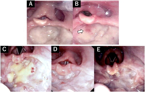Figure 3. Endoscopic images after hemostasis. (A) Wound at postoperative day (POD) 14. (B) On POD 28, some granulation was seen (arrow). (C) On POD 41, the wound gradually healed. (D) On POD 83, the perforation of the epiglottis had contracted and was no longer visible. (E) On POD 160, 2 weeks after direct swallowing training was started.
