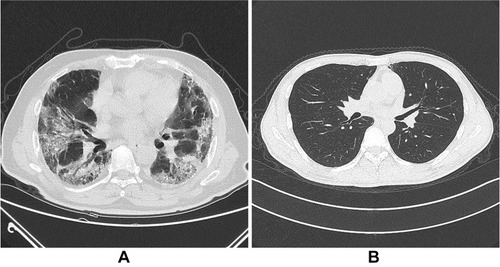 Figure 1 The chest CT image dataset (A is COVID-19, B is non-COVID-19).