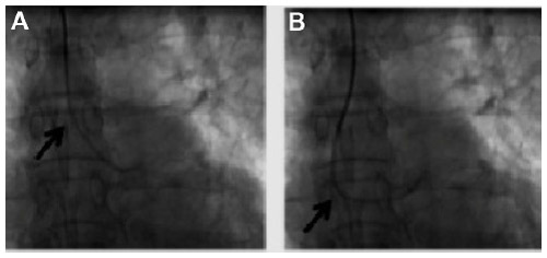 Figure 7 Power position of catheter when performing left percutaneous coronary intervention with a Judkins left catheter.