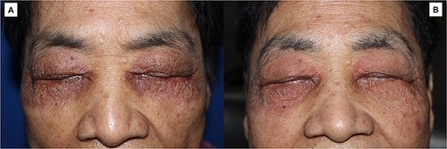 Figure 1 (A) Bilateral ill-defined pruritic scaly erythematous plaques with minimal crusts on the periorbital area after the third cycle of modified FOLFOX6 plus panitumumab therapy. (B) Recurrence of similar periorbital lesions after the fifth cycle of therapy.