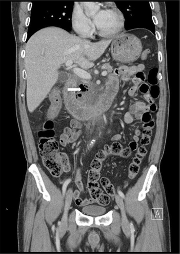 Figure 1 Abdominal CT showing loculated fluid collection with abundant air bubbles (white arrow) around duodenal second and third portions in anterior pararenal space.