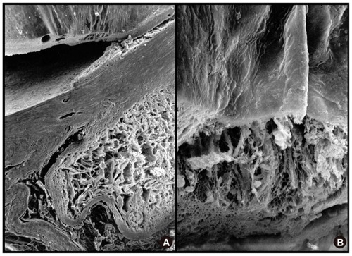 Figure 5 SEM showing extensive cavernous atrophy of the optic nerve. (A) SEM showing extensive cavernous atrophy of the optic nerve with an intact subarachnoid space. (B) higher magnification SEM of cavernous atrophy of the optic nerve with a wall of intact glial tissue surrounding this area (upper portion of image).
