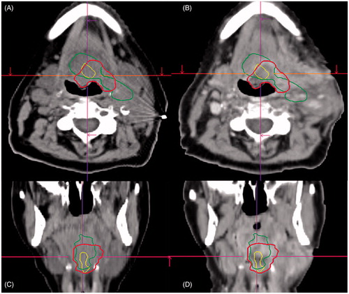 Figure 1. Example images of patient #3. Planning CT (A and C) and deformed CT of the recurrence (B and D) with the VOI in green VH, in yellow VM and in red the GTVRec.
