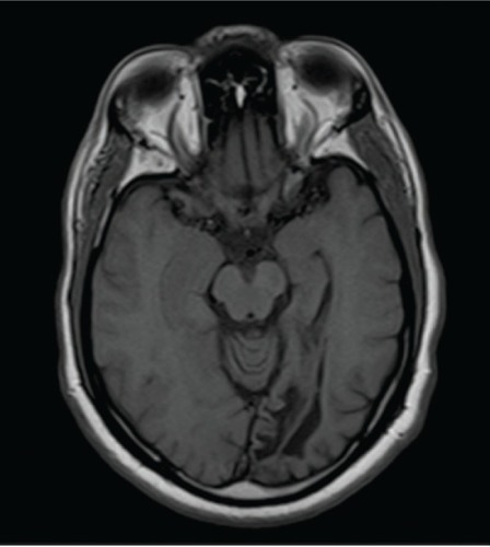 Figure 3 Axial T1-weighted magnetic resonance image of patient 1 demonstrating encephalomalacia of the left occipital lobe.