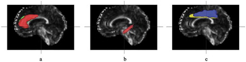 Figure 1. MRI images with ROIs marked. A: anterior cingulate gyrus, B: posterior cingulate gyrus, C: middle cingulate gyrus