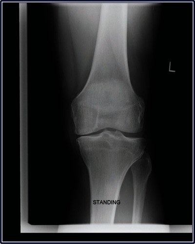 Figure 2 Weight-bearing radiograph of left knee demonstrating moderate narrowing of the medial joint space.