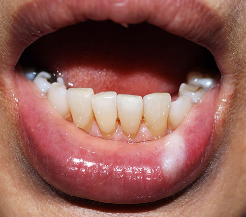 Figure 1 Clinical manifestation: well-defined whitish, slightly firm plaque on the left side of the lower labial mucosa and subtle white striation on the right side of the lower labial mucosa.