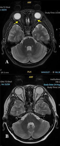 Figure 3 (A) A slight thickening and T2 hyperintense signal of the orbital anterior segments of the both optic nerve. The yellow arrow indicates the slight thickening of the nerve. (B) T2WI of the optic nerve.