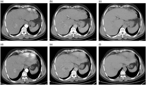 Figure 7. A 54-year-old man with a history of antiviral treatment for hepatitis C virus. Contrast-enhanced CT before treatment: (a) arterial, (b) portal, and (c) delayed phases show a single 4.4 cm focal lesion at segment VII with HCC criteria (arterial enhancement and delayed washout). MWA was performed and results of follow up contrast-enhanced CT after 12 months are shown: (d) arterial, (e) portal, and (f) delayed phases show tumor recurrence with significant enhancement at the arterial phase and characteristic washout at the delayed phases.