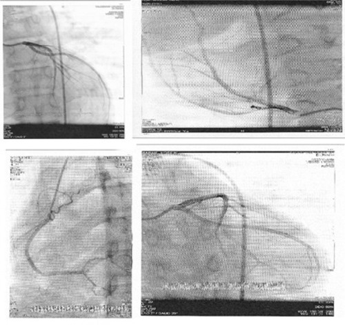 Figure 3 Echocardiogram and coronary angiography of patient reported normal and showed no signs of coronary artery aneurysm.