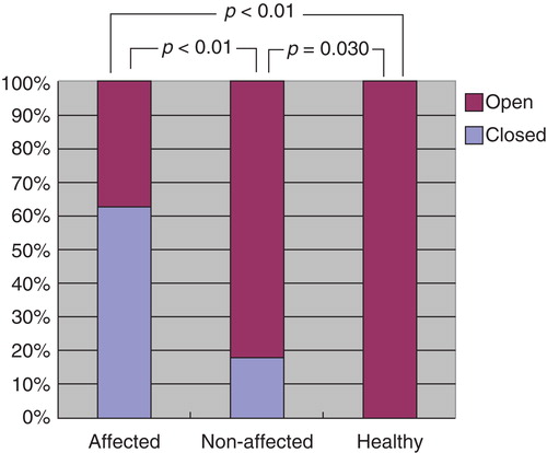 Figure 7. Distribution pattern of the endolymphatic sinus (ES) in affected and non-affected ears of patients with Meniere's disease (MD) and healthy ears of volunteers.