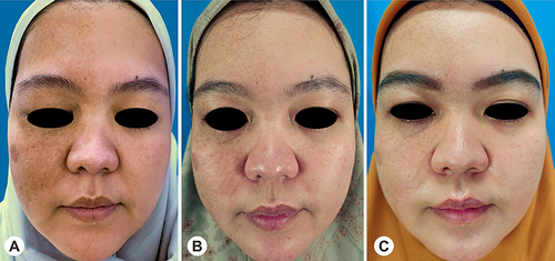 Figure 3 Comparison of hyperpigmented macules on the forehead and right cheek. (A) Before treatment. (B) After one session of treatment. (C) After two sessions of treatment.