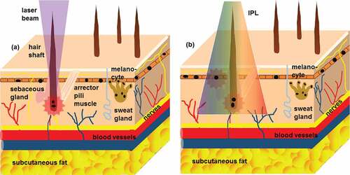 Figure 1. Mechanism of action of laser and IPL hair removal.