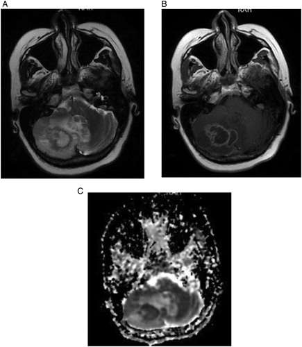 Figure 3. T2-weighted (A) and postcontrast T1-weighted (B) brain MR images in the axial plane shows a right cerebellar mass lesion, with peripheral enhancement and accompanying edema causing mild midline shift. Apparent diffusion coefficient map (C) generated from diffusion-weighted study performed at the same anatomic level depicts diffusion restriction, enabling the diagnosis of an abscess.