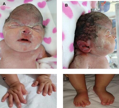 Figure 2 Physical findings at birth. (A and B). Female newborn with cloverleaf skull, hypertelorism, facial hypoplasia, low ears, exophthalmos, (C) short and deviated hallux and (D) thumbs.