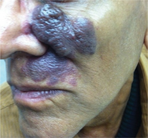 Figure 1 An untreated facial capillary malformation (port-wine stain) in a 60-year-old man who presented with a complaint of progressive darkening and development of nodularity in his adult years.