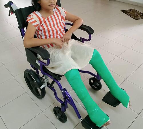 Figure 4 Long-leg bent-knee cast was convenient for wheelchair mobilization and car rides.