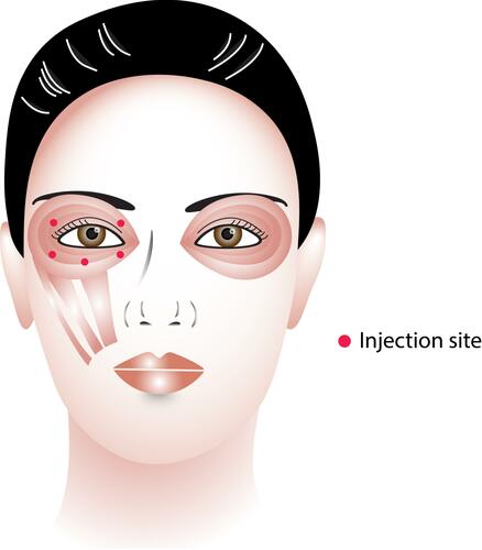 Figure 1 Dosage and injection sites of botulinum toxin (Image courtesy of Supanut Apinyawasisuk, MD).