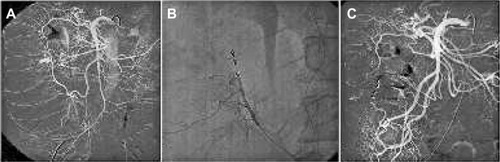 Figure 3 Lower intestinal hemorrhage treatment.