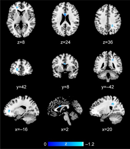 Figure 3 AES-SDM results of the effect of risk allele on white matter.
