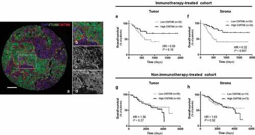 Figure 1. Distribution of CMTM6 expression and its indicative value in human melanoma tissue. A-D) Representative case with tumor and immune cells positive for CMTM6, being a) an overlapped image of the whole core with DAPI (nuclei) in blue, TUM (tumor cells = HMB45+ and S100+) in green, and CMTM6 in red (scale bar = 100 µm); b-d) region from (a) image showing the three channels overlapped (b), only CMTM6 (c), and only TUM (d). Overall survival based on CMTM6 expression in the tumor (e) and stromal (f) compartments in patients treated with immunotherapy, and overall survival for the non-immunotherapy-treated cohort based on CMTM6 expressed in tumor (g) or in stroma (h)