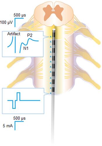 Figure 2 Segment of spinal cord with stimulation applied to the dorsal columns one end of a lead, with the resultant evoked compound action potential (ECAP) and associated artifact measured on the opposite end. N1 and P2 refer to the first trough and second peak, respectively, of the ECAP.