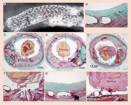 Figure 1. Histological sections showing stent thrombosis in a patient with acute myocardial infaction.An 81-year-old male died suddenly 2 months after Taxus™ stent implantation in the left anterior descending artery for acute myocardial infaction. (A) Radiograph showing the area of plaque rupture (C, D & E) with three histologic sections. (B & D) Low-power sections of site of plaque rupture with (F) corresponding high powers. Note absence of fibrous cap and lack of stent coverage with overlay platelet-rich thrombus mixed with red cells. (D & E) Nonculprit sites with neointimal coverage of stent struts (boxed areas) and (G & B) persistant fibrin deposition. (E & H) Low and high powers of adjoining area of calcification at the site of plaque rupture (arrow). (H) Note fibrin coverage of stent struts, which are overlying an area of calcification with luminal platelet rich thrombus.