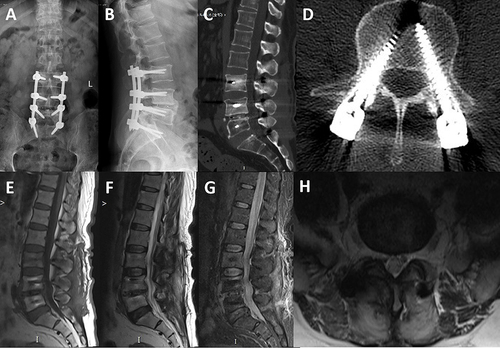 Figure 5 Typical cases of perioperative quadruple chemotherapy. X-ray 3 months postoperatively: no loosening of the internal fixation (A and B); CT 3 months postoperatively: bone damage from the lesion was evidently repaired (C and D); MRI 3 months postoperatively: a good repair was achieved for the diseased intervertebral disc as well as its adjacent soft tissues (E–H).