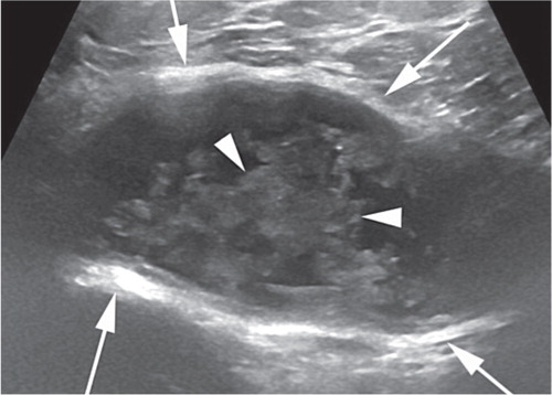 Figure 2. Example of an ultrasound finding classified as a mixed-type pseudotumor. An anterior image showing a thick-walled, mixed-type pseudotumor. Solid contents (arrowheads) can be seen among the hypoechoic fluid content. This lesion was graded as mixed-type because of the thick walls and atypical contents.