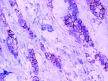 Figure 1. Expression of HER2 in cancer tissue visualized by immunohistochemistry.