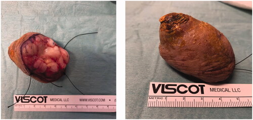 Figure 2. Post-excisional photographs of tumor: inferior (A) and lateral (B) views.