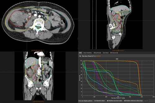 Figure 4 The irradiated gross tumor volume and the radiation dose plan.