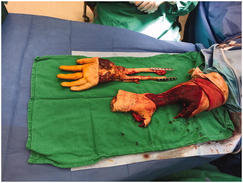 Figure 5. Operative method demonstrating removal of the amputated part from the right forearm, and remaining pedicled fillet flap and stump defect.