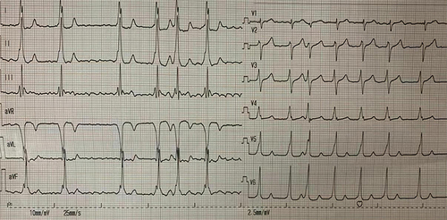 Figure 1 The electrocardiogram of patient I showed atrial fibrillation and pre-excitation pattern (The absence of variability of the pre-excited QRS complex in the setting of atrial fibrillation is highly suggestive of a fasciculoventricular pathway).