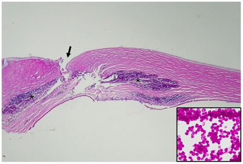 Figure 2 Histopathologic analysis of keratectomy specimen.