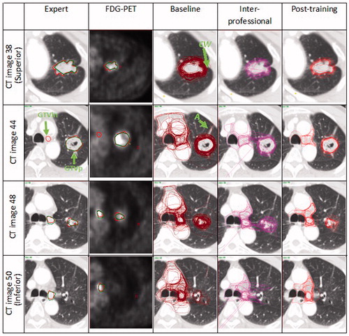 Figure 1. Expert delineations (radiation oncologist in red and radiologist in green) compared with the baseline, interprofessional and post-training delineations for the courses held in Tours 2009 on the 4 CT images selected by the expert. Note that for the GTVp the interprofessional and post-training delineations had a lower interobserver variation particularly for regions with atelectasis (A) and chest wall (CW). The outlier (O) on the interprofessional delineations could be related to lack of familiarity with using the delineation software. For the GTVln, there was a significant improvement for the interprofessional and post-training delineations as most participants relied more on the FDG PET-CT and included only the involved lymph nodes in the delineations. Another factor leading to interobserver variation when delineating the GTVln was that while some participants outlined only the active lymph node on the FDG PET-CT, other participants delineated the lymph node station. (Refer to online version for colored images).