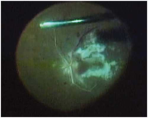 Figure 1. Fundus of left eye during vitrectomy. During vitreous surgery, a yellowish white retinal exudative lesion involving the posterior pole and whitening inside vascular arcades are observed, both of which are atypical findings of PDR. Proliferative membrane was around the disc.