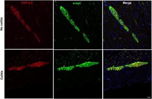 Figure 4 Double immunofluorescence images of proximal colon showing α-syn colocalization with pan-neuronal marker PGP9.5 in myenteric ganglia of no-colitis control (MO2) and colitis (LM9) cynomolgus macaques. Scale bar = 50µm for all panels.