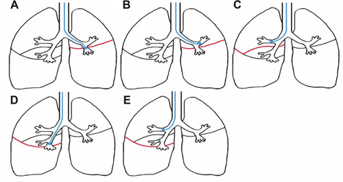 Figure 1 Measurement of collateral flow with Chartis. (A) and (B) Collateral flow over the left major fissure (red) is measured by a balloon occluding the entrance of the left lower lobe (A) or the left upper lobe (B). (C) Collateral flow over the right upper lobe fissure is measured in the right upper lobe. This fissure consists of the minor fissure and a part of the right major fissure (red). (D) Collateral flow over the right major fissure (red) is measured by a balloon occluding the entrance of the right lower lobe. If this is unsuccessful, (E) collateral flow can be measured in the right upper lobe while the middle lobe is also occluded with a Fogarty balloon or a Watanabe spigot (green).