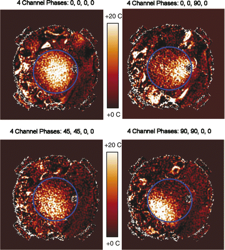 Figure 9. Shifting of temperature rise within the phantom as measured by MRTI for four different antenna phase set-ups. Note the visual correlation of MR measured shift of focal heating with the theoretical simulations of Figures 7 and 8. 120 mm diameter phantom outline shown in blue.