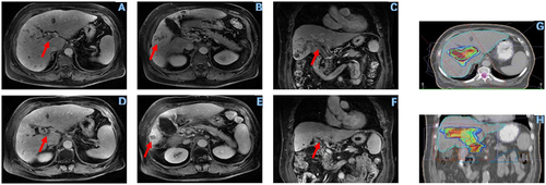 Figure 4 Typical case demonstration. A 69-year-old male HCC patient with main PVTT achieved complete response (mRECIST) after receiving Lenvatinib plus Pembrolizumab combined with Radiotherapy. Sub-figure A B C show the pre-treatment images and sub-figure D E F show the post-treatment images. Sub-figure G H show the radiotherapy target area. The red arrows in the sub-figure A and C indicate the range of PVTT before treatment. The red arrow in the sub-figure B indicate the range of liver tumor before treatment. The red arrows in the sub-figure D and F indicate the range of PVTT after treatment. The red arrow in the sub-figure E indicate the range of liver tumor after treatment. After treatment, the liver tumor and PVTT had shrunk and there was no enhancement on the enhanced image.