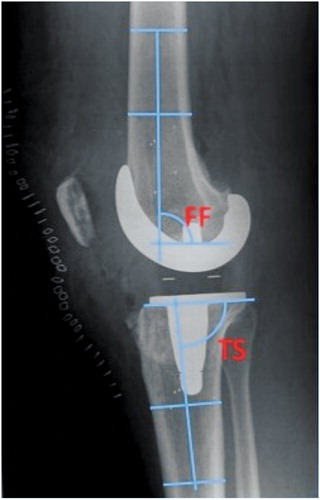 Figure 2. Example of measurements of femoral and tibial TKA component placement in the sagittal plane with respect to the femoral and tibial anatomical axes, respectively, according to Petersen and Engh (Citation1988) and as used by e.g. Ritter et al. (Citation2011). Flexion of the femoral component is measured as the angle (FF) between the line across the bottom of the femoral implant and the femoral shaft axis. FF = 90 corresponds to neutral placement, FF > 90 corresponds to femoral component in extension, and FF < 90 corresponds to femoral component in flexion.Tibial slope* is measured as the angle (TS) between the line across the bottom of the tibial plate and the tibial shaft axis. TS = 90 correponds to neutral placement, TS > 90 corresponds to anterior tibial slope*, and TS < 90 corresponds to posterior tibial slope*.* Some component types have posterior slope built into the implant design.