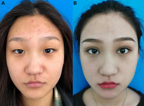 Figure 8 (A) Photograph of the patient who was not satisfied with her appearance. (B) At the end of 6 months post-operation, the patient was satisfied with the results and became more confident.