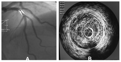 Figure 2 A) Quantitative coronary angiography of a 45-year-old patient with typical angina showed significant stenosis in middle of the left anterior descending coronary artery and degree of coronary diameter stenosis is 65%. B) Corresponding intravascular ultrasound image of the plaque in the same patient, minimal luminal cross-sectional area is 3.7 mm2 and external elastic membrane cross-sectional area is 15.1 mm2.