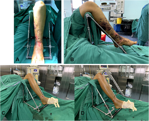 Figure 3 Intraoperative view of minimally invasive traction repositor (MITR) application. A 20-year-old female patient with comminuted fracture of the left tibia. (A) Anteroposterior view. (B) Lateral view. A 48-year-old male patient with distal third fracture of the right tibia. (C) The MITR is connected and applied to the affected limb. (D) The minimally invasive incision for closed reduction of the tibia fracture and intramedullary nail insertion.