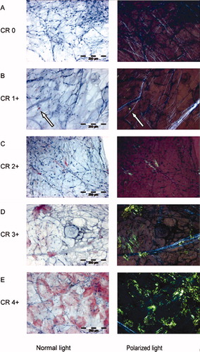 Figure 1. Examples of Congo red (CR)-scored fat smears in normal light (red-stained deposits) and polarized light (green birefringence). (A) Grade 0 (negative). (B) Grade 1+ (minute, <1% of surface area), the arrow points to Congo red-positive material. (C) Grade 2+ (little, between 1% and 10%). (D) Grade 3+ (moderate, between 10% and 60%). (E) Grade 4+ (abundant, >60%).
