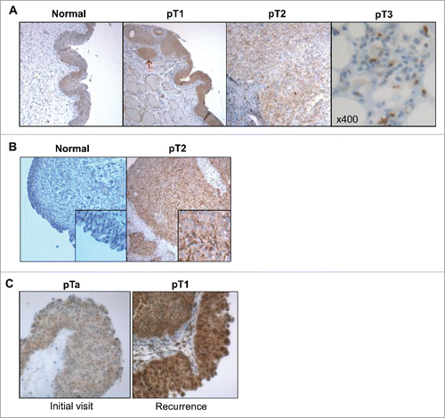 Figure 2. IL-5Rα expression in normal and bladder cancer primary specimens at various pathology stages by IHC. Representative examples from individual patients of the increase in IL-5Rα protein expression levels in healthy versus cancer specimens. (A) One patient whose bladder contained normal urothelium and tumors with TNM stages pT1, pT2, and pT3. In the pT1 specimen, IL-5Rα-positive nests are observed (red arrow) within the lamina propria. In the pT2 and pT3 specimens, there is dissemination of IL-5Rα-positive tumor cells in the lamina propria and fat, respectively. (B) Another patient whose bladder contained normal urothelium versus pT2 tumor tissue. (C) Patient with tumor specimens obtained at initial visit and follow-up visit for tumor recurrence. Images are at ×40 magnification except for image of pT3 tumor in A, which is at ×400 magnification.