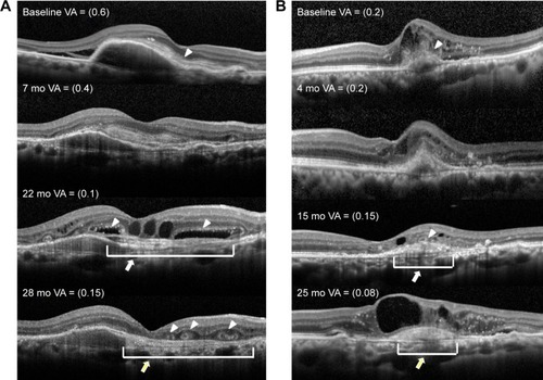 Figure 2 Pathological changes in optical coherence tomography findings that precede the formation of subretinal hyperreflective material and ORT.