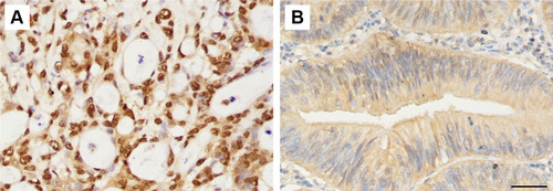 Figure 2 Staining of mono-ADP-ribose binding reagent in colorectal adenocarcinoma tissue samples. (A) Strongly positive staining (×400). (B) Slight positive staining (×400). Scale bar=50μm.